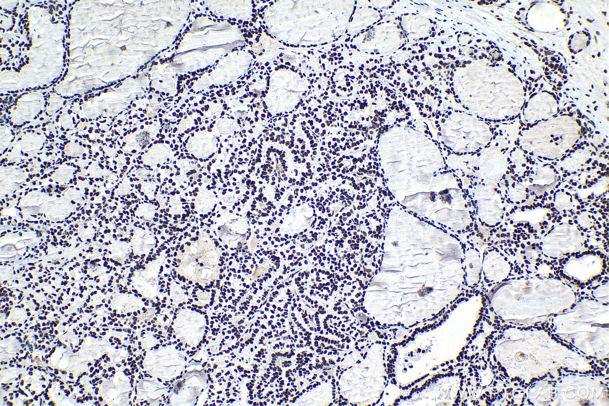 Immunohistochemical analysis of paraffin-embedded human thyroid cancer tissue slide using KHC1566 (U2AF2 IHC Kit).