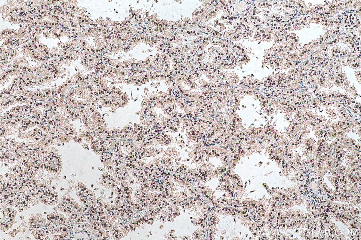 Immunohistochemical analysis of paraffin-embedded human lung cancer tissue slide using KHC0679 (UBA1 IHC Kit).