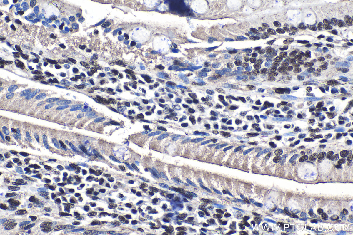 Immunohistochemical analysis of paraffin-embedded human stomach cancer tissue slide using KHC1394 (UBA2 IHC Kit).