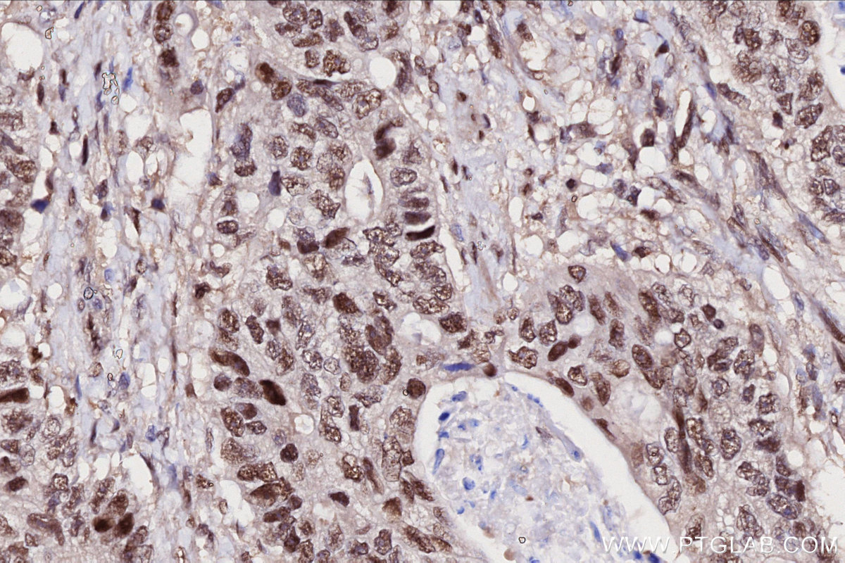 Immunohistochemical analysis of paraffin-embedded human stomach cancer tissue slide using KHC2708 (UBA3 IHC Kit).
