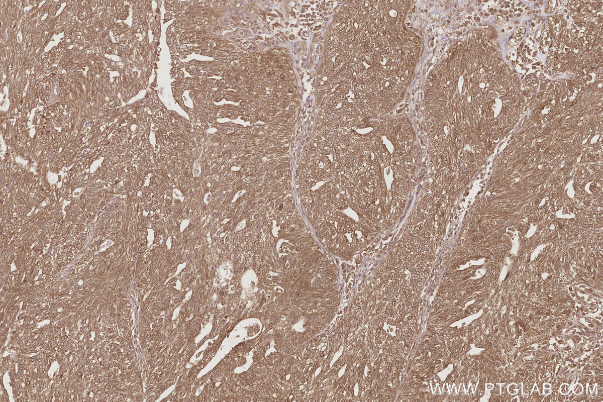 Immunohistochemical analysis of paraffin-embedded human ovary cancer tissue slide using KHC2862 (UBAC1 IHC Kit).