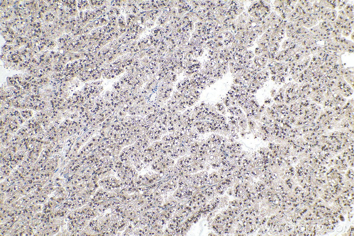 Immunohistochemical analysis of paraffin-embedded human lung cancer tissue slide using KHC0905 (UBE2I/UBC9 IHC Kit).