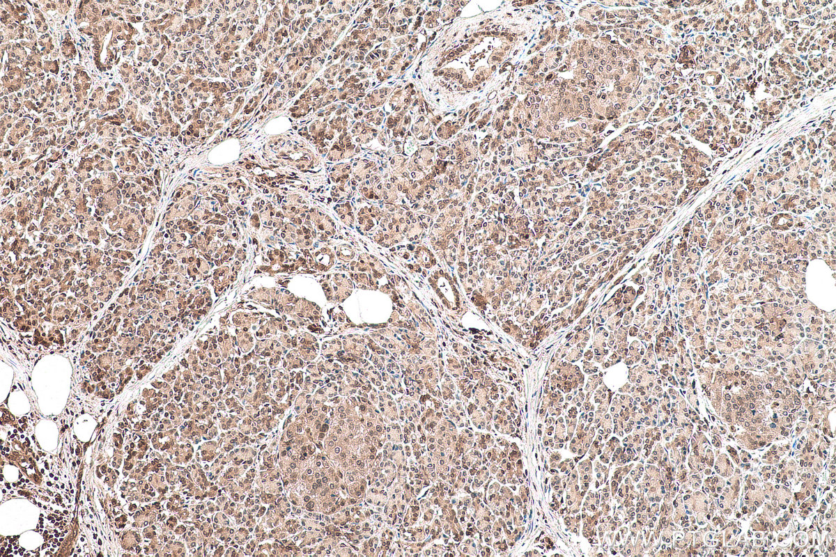 Immunohistochemical analysis of paraffin-embedded human pancreas cancer tissue slide using KHC0905 (UBE2I/UBC9 IHC Kit).