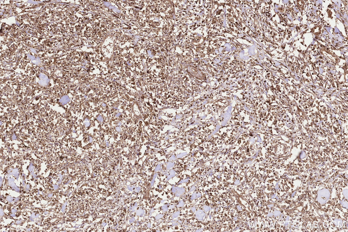 Immunohistochemical analysis of paraffin-embedded human colon cancer tissue slide using KHC3235 (UBE2M/UBC12 IHC Kit).