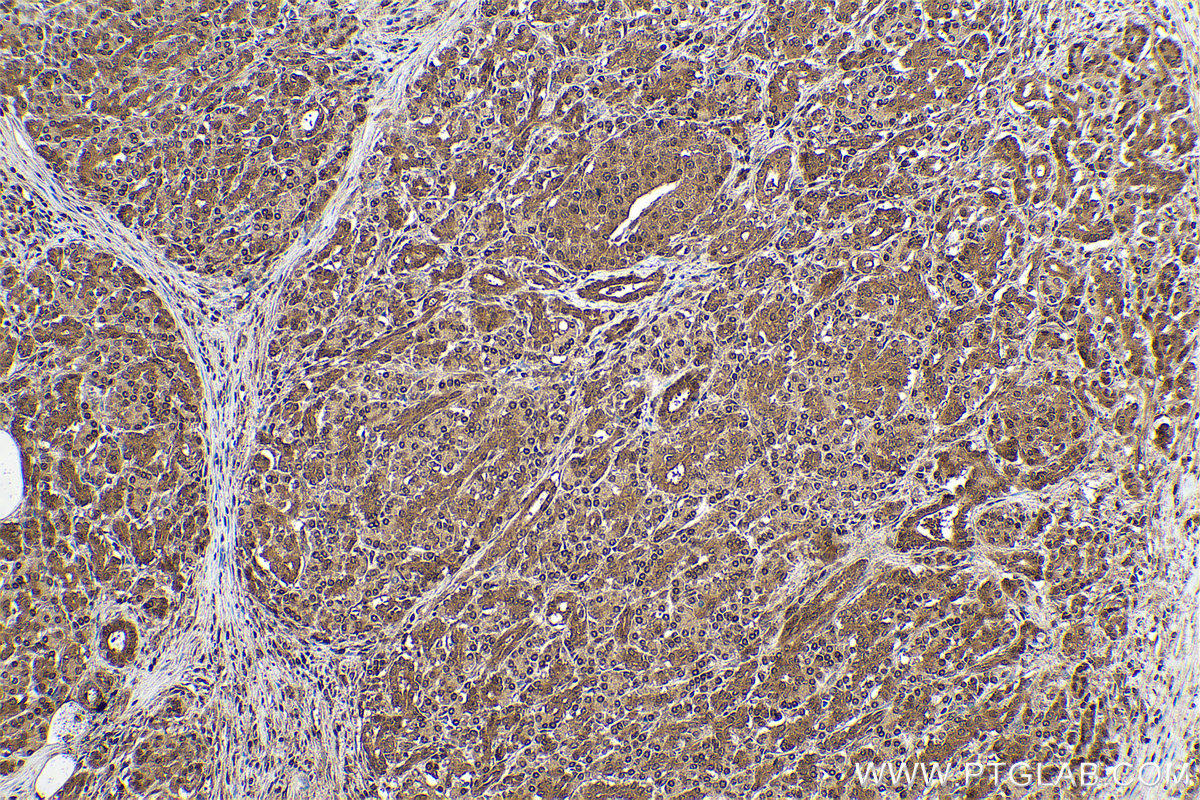 Immunohistochemical analysis of paraffin-embedded human pancreas cancer tissue slide using KHC0872 (UBE2N IHC Kit).