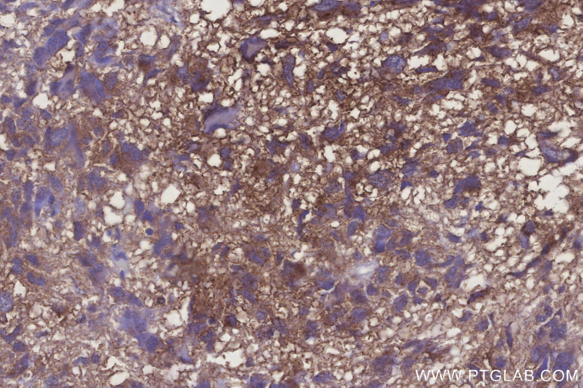 Immunohistochemical analysis of paraffin-embedded human Glioblastoma tissue slide using KHC3276 (UBE2R2 IHC Kit). Immunohistochemical analysis of paraffin-embedded human Glioblastoma tissue slide using KHC3276 (UBE2R2 IHC Kit).