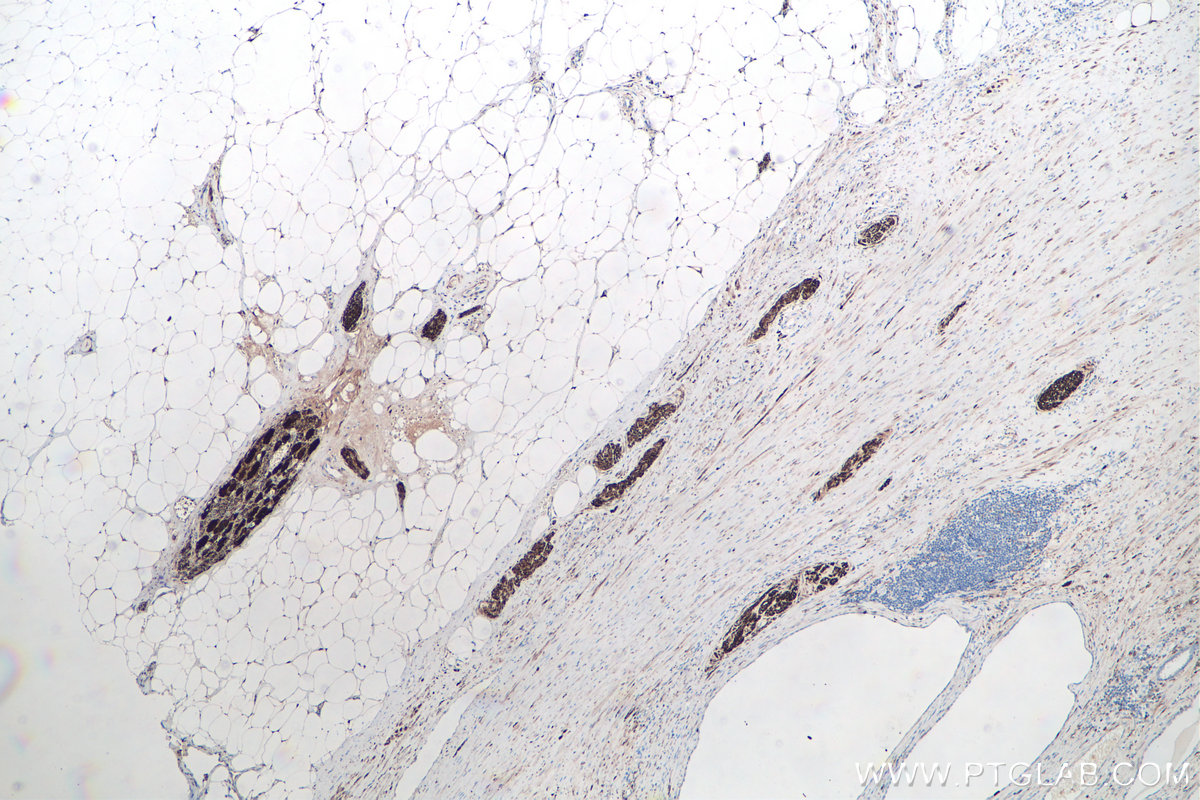 Immunohistochemical analysis of paraffin-embedded human prostate cancer tissue slide using KHC0054 (UCHL1 IHC Kit).