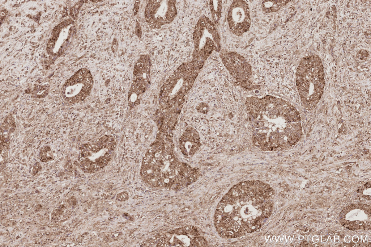 Immunohistochemical analysis of paraffin-embedded human pancreas cancer tissue slide using KHC3078 (UCHL5 IHC Kit). Immunohistochemical analysis of paraffin-embedded human pancreas cancer tissue slide using KHC3078 (UCHL5 IHC Kit).