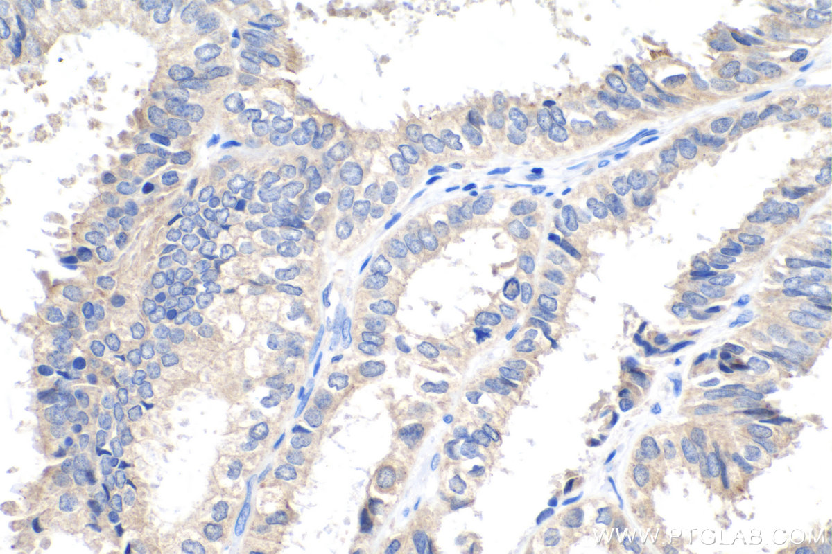 Immunohistochemical analysis of paraffin-embedded human ovary tumor tissue slide using KHC0247 (UCP2 IHC Kit).