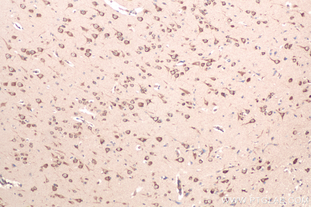 Immunohistochemical analysis of paraffin-embedded human gliomas tissue slide using KHC0949 (UFM1 IHC Kit).