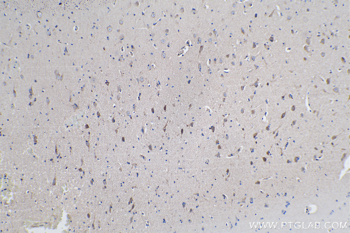 Immunohistochemical analysis of paraffin-embedded human gliomas tissue slide using KHC0266 (ULBP2 IHC Kit).