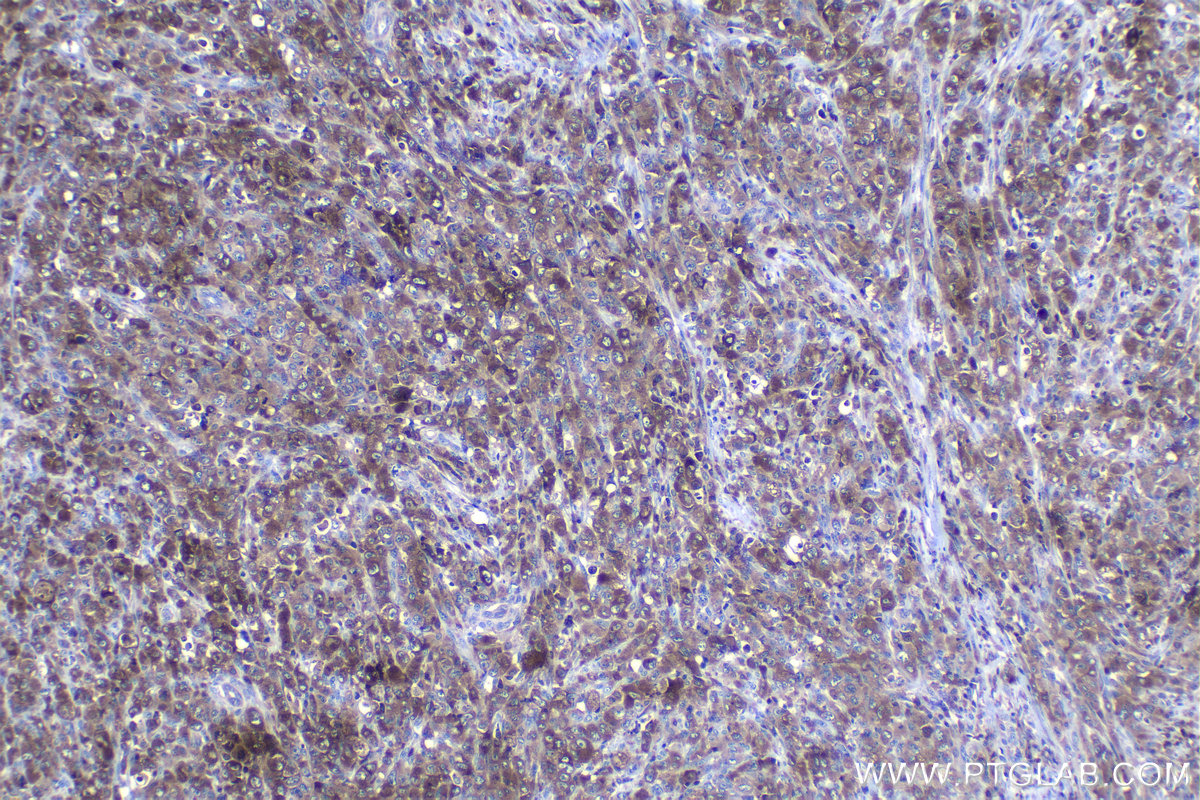 Immunohistochemical analysis of paraffin-embedded human lymphoma tissue slide using KHC1158 (UNC13D IHC Kit).