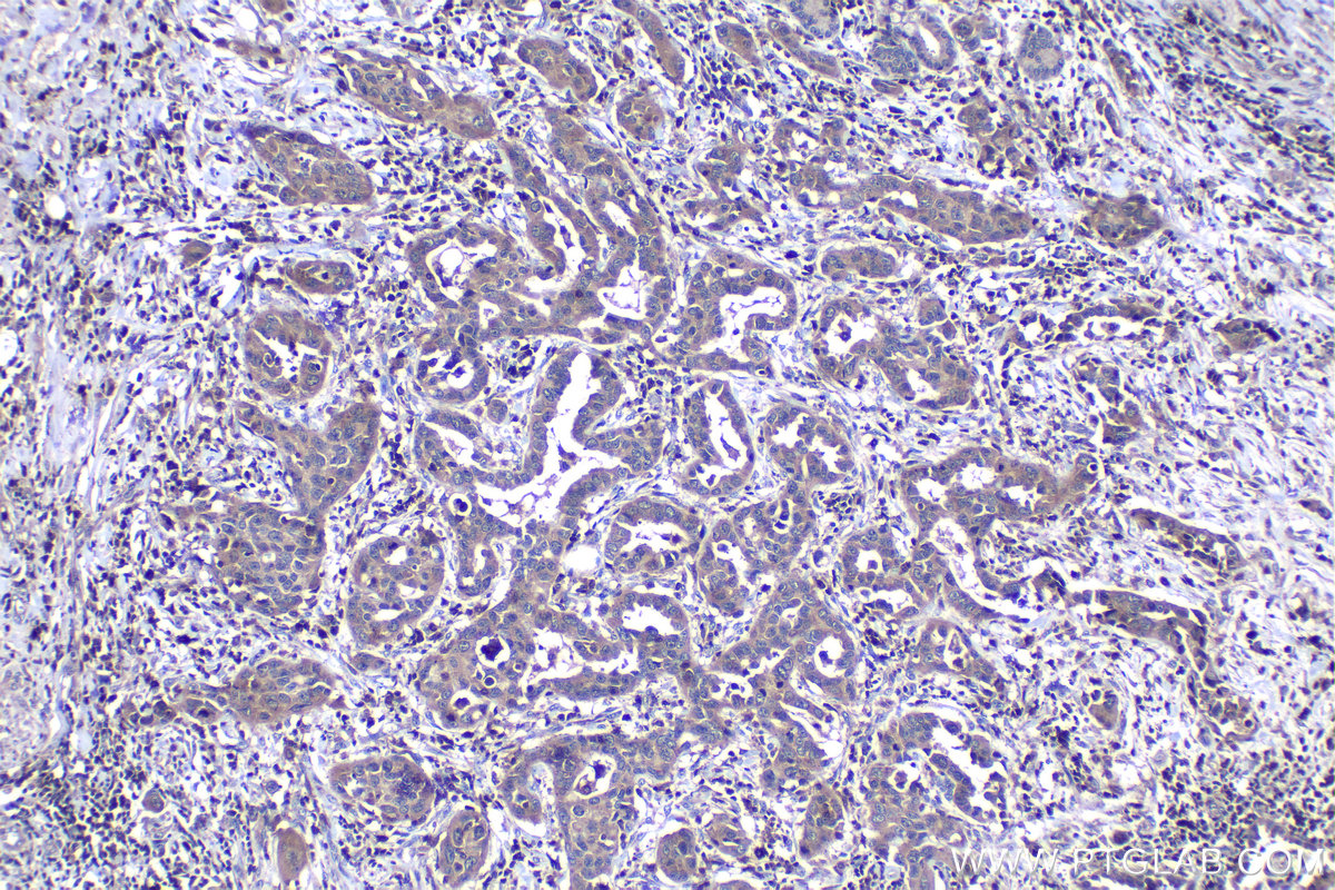 Immunohistochemical analysis of paraffin-embedded human lung cancer tissue slide using KHC1158 (UNC13D IHC Kit).