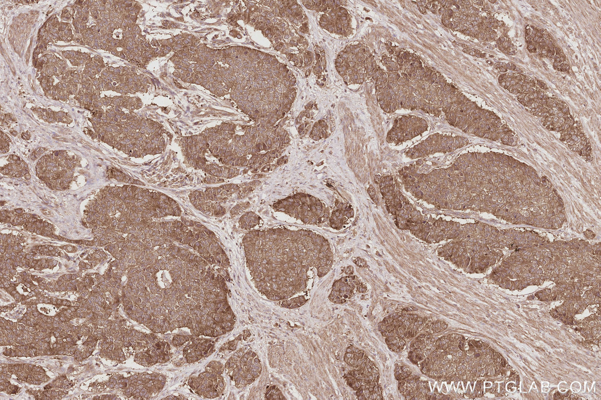 Immunohistochemical analysis of paraffin-embedded human stomach cancer tissue slide using KHC2913 (UNC45A IHC Kit).