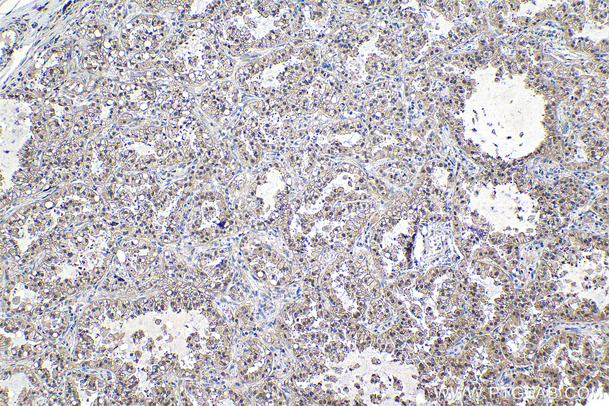 Immunohistochemical analysis of paraffin-embedded human lung cancer tissue slide using KHC1170 (UNG IHC Kit).