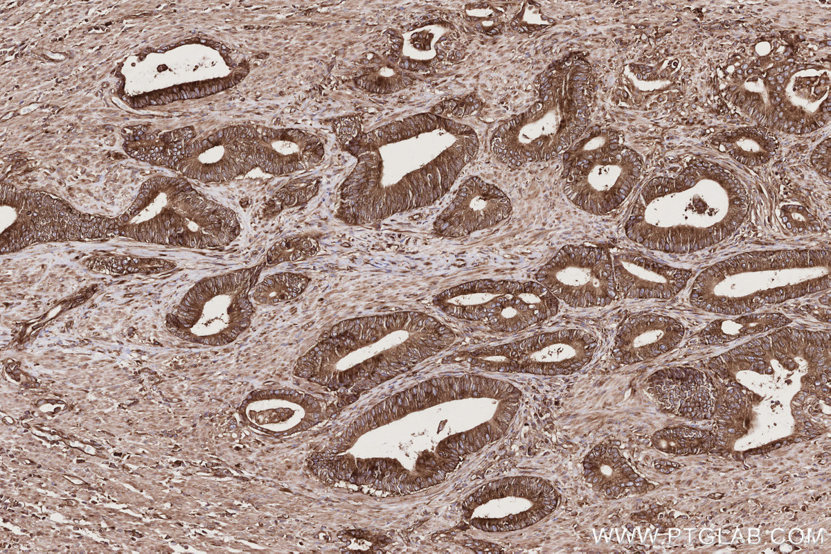 Immunohistochemical analysis of paraffin-embedded human rectal cancer tissue slide using KHC2765 (UPF1 IHC Kit).