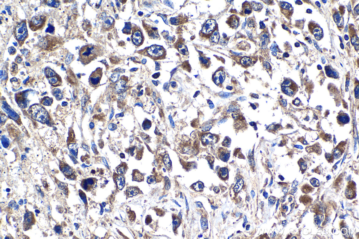 Immunohistochemical analysis of paraffin-embedded human lung cancer tissue slide using KHC1237 (UPP1 IHC Kit).