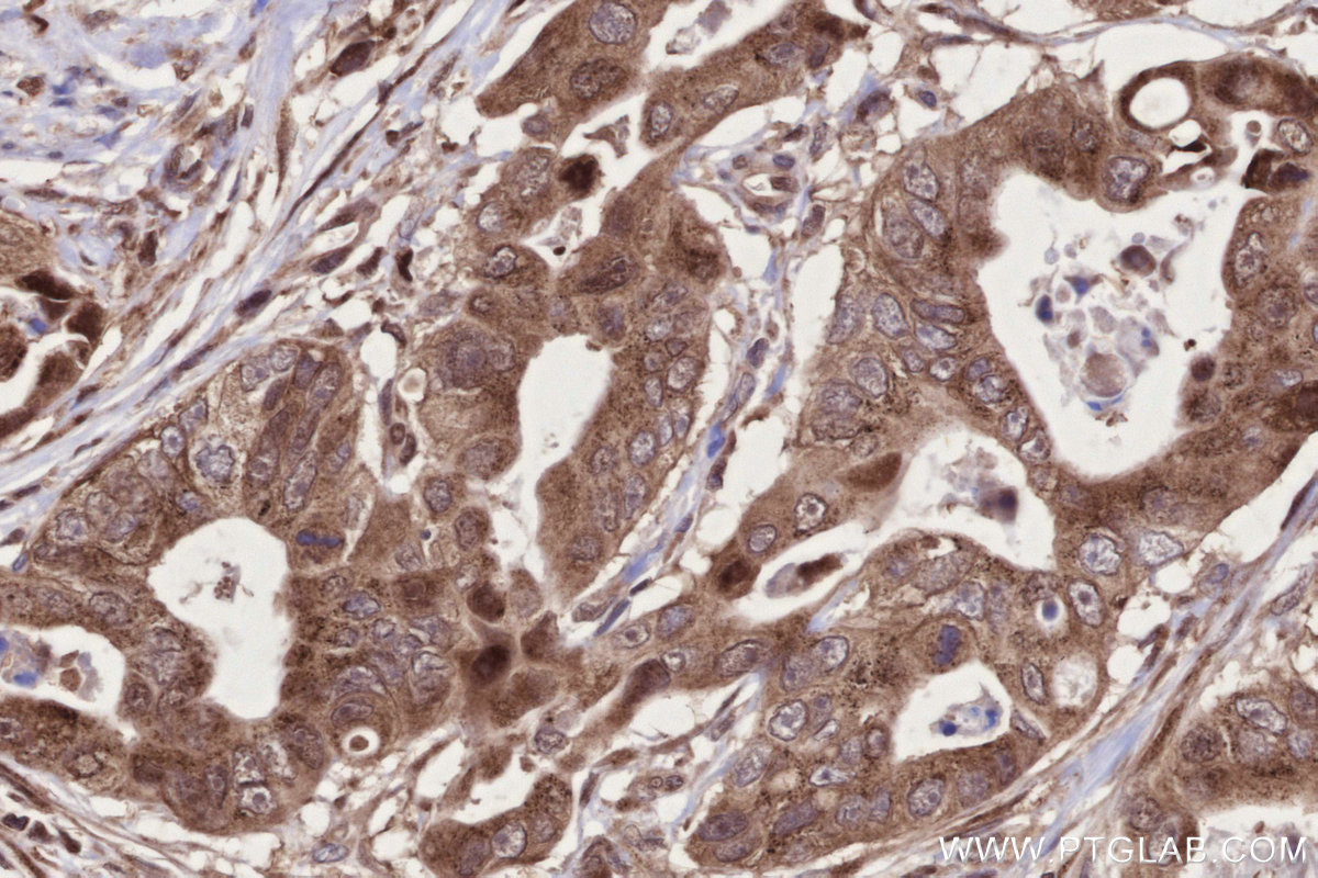 Immunohistochemical analysis of paraffin-embedded human stomach cancer tissue slide using KHC2714 (URG4 IHC Kit).