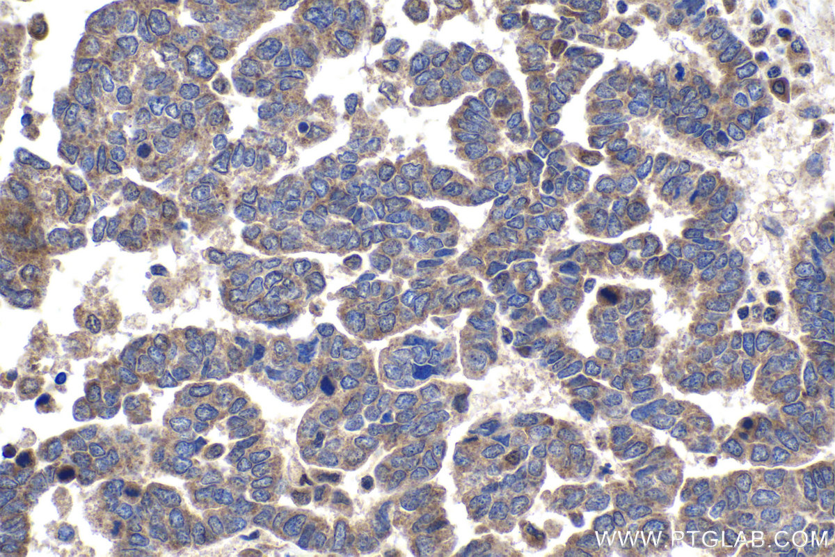 Immunohistochemical analysis of paraffin-embedded human ovary tumor tissue slide using KHC1770 (USH1G IHC Kit).
