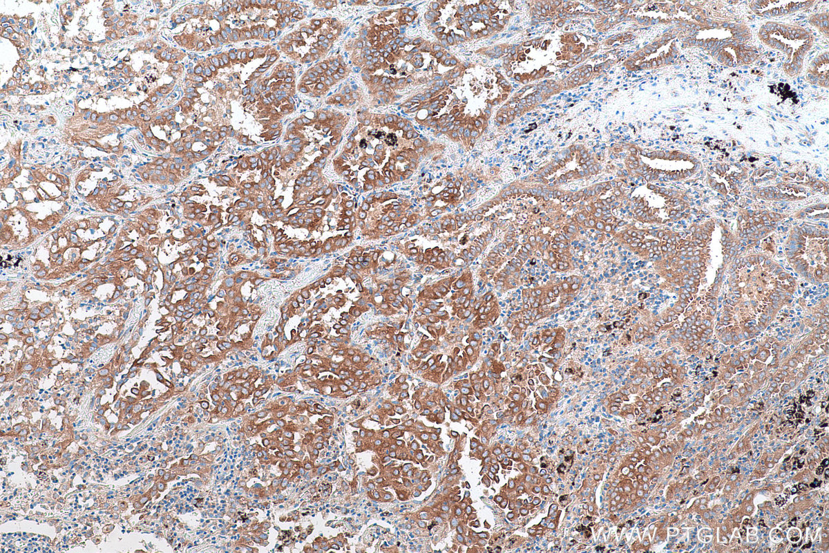 Immunohistochemical analysis of paraffin-embedded human lung cancer tissue slide using KHC0884 (USO1 IHC Kit).