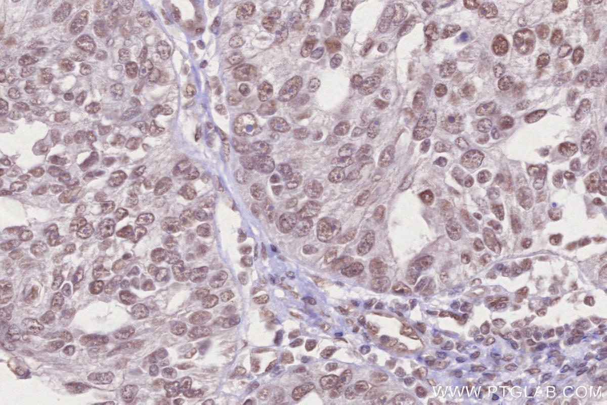Immunohistochemical analysis of paraffin-embedded human ovary cancer tissue slide using KHC2631 (USP37 IHC Kit).