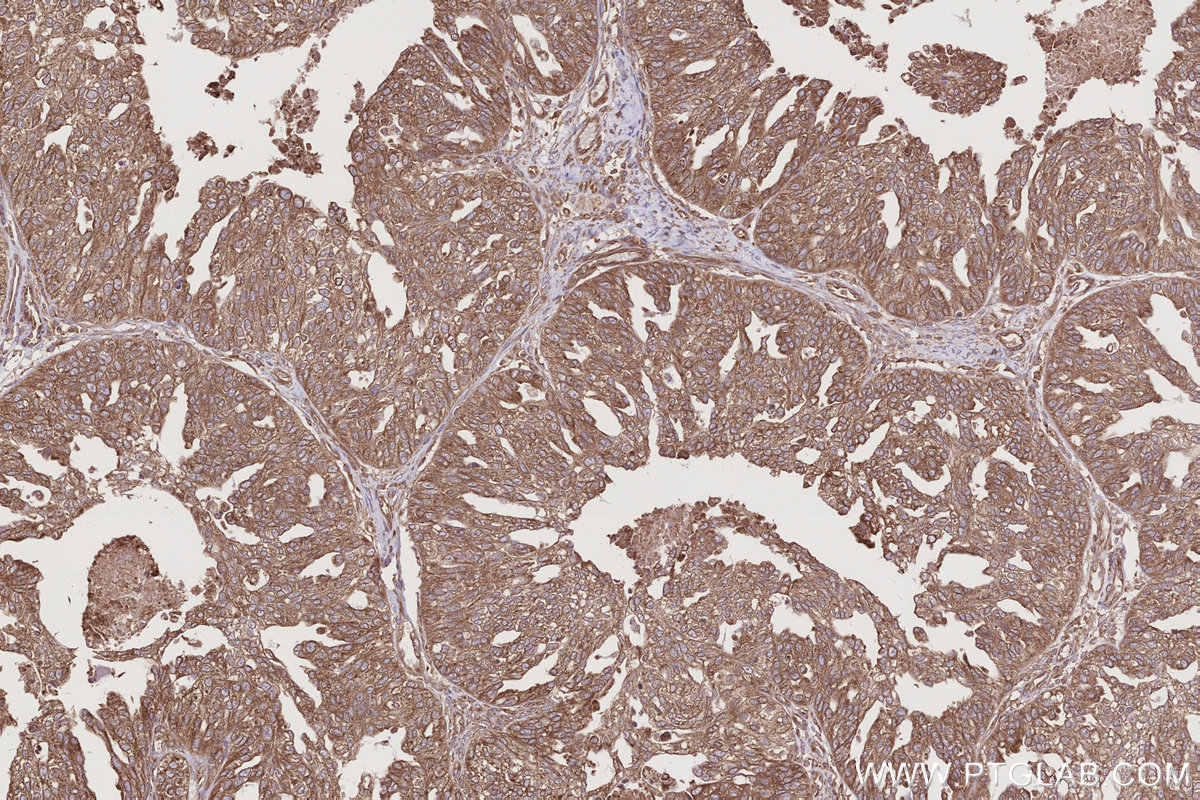 Immunohistochemical analysis of paraffin-embedded human ovary cancer tissue slide using KHC2770 (USP9X IHC Kit).