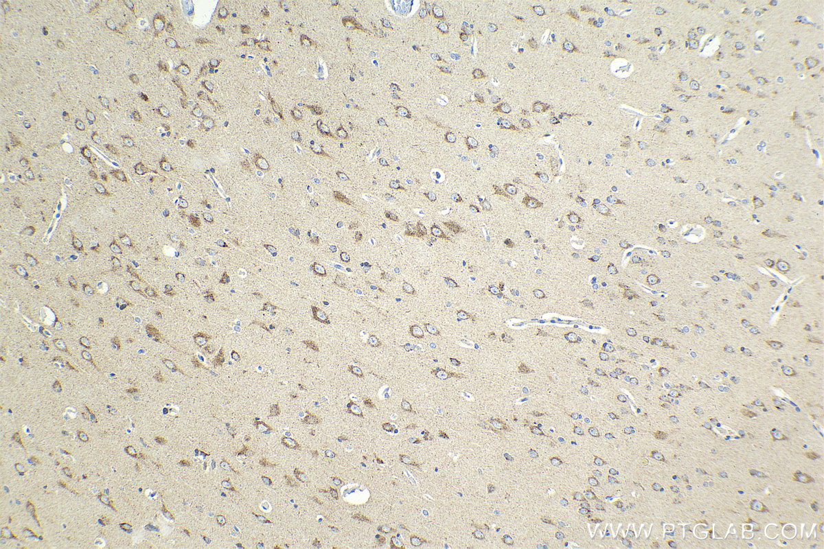Immunohistochemical analysis of paraffin-embedded human gliomas tissue slide using KHC2110 (VAMP4 IHC Kit).