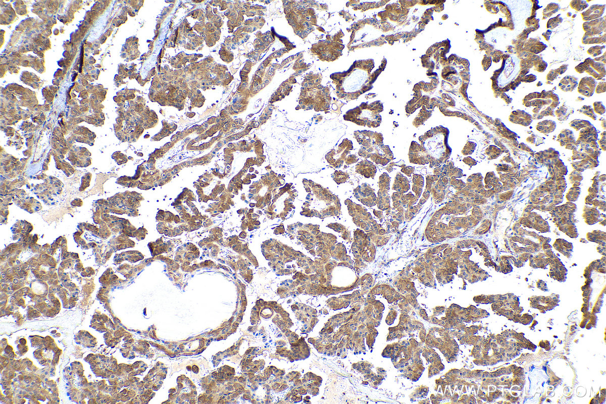 Immunohistochemical analysis of paraffin-embedded human thyroid cancer tissue slide using KHC0944 (VBP1 IHC Kit).