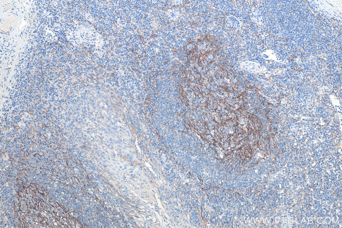 Immunohistochemical analysis of paraffin-embedded human tonsillitis tissue slide using KHC0106 (VCAM-1 IHC Kit).