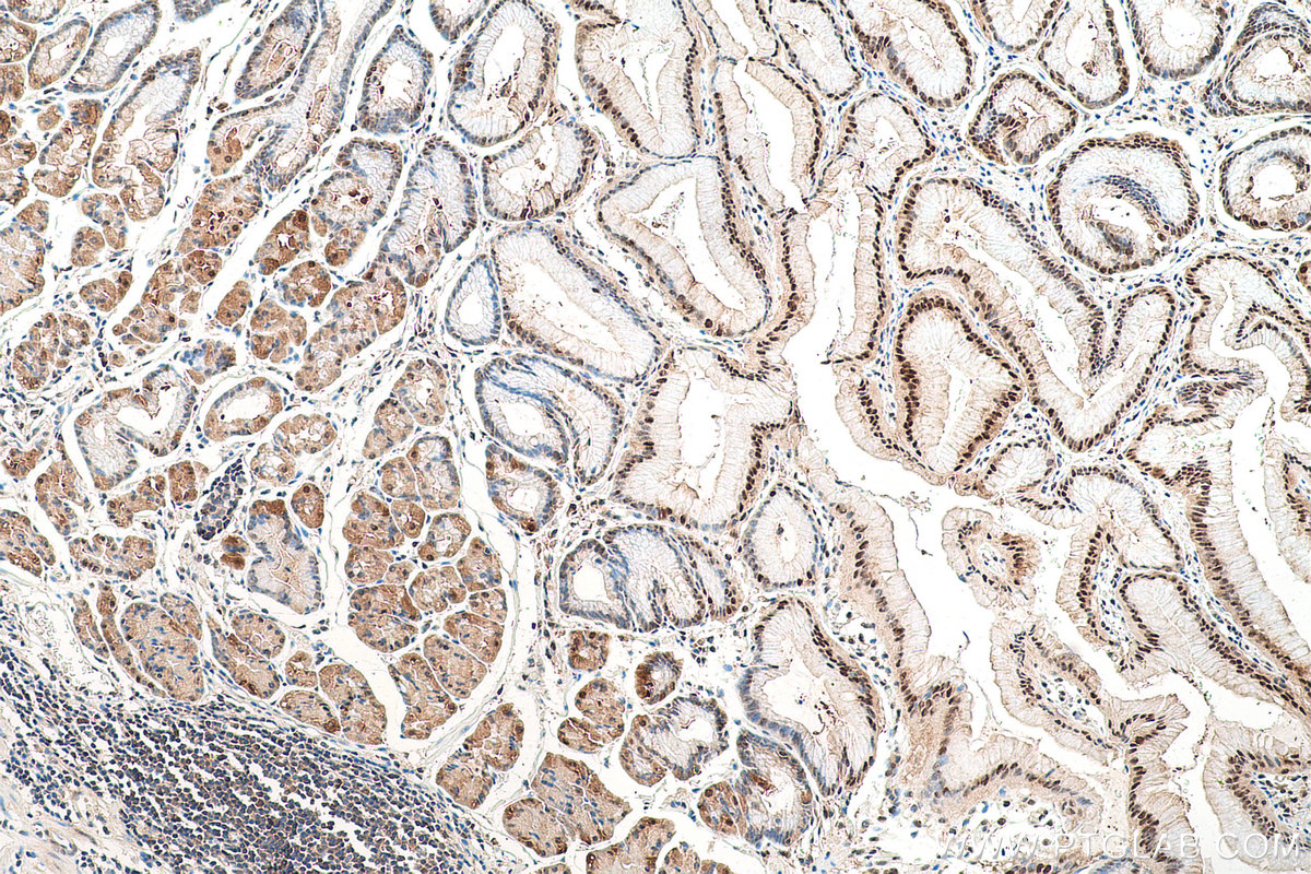 Immunohistochemical analysis of paraffin-embedded human stomach cancer tissue slide using KHC0830 (VCP IHC Kit).