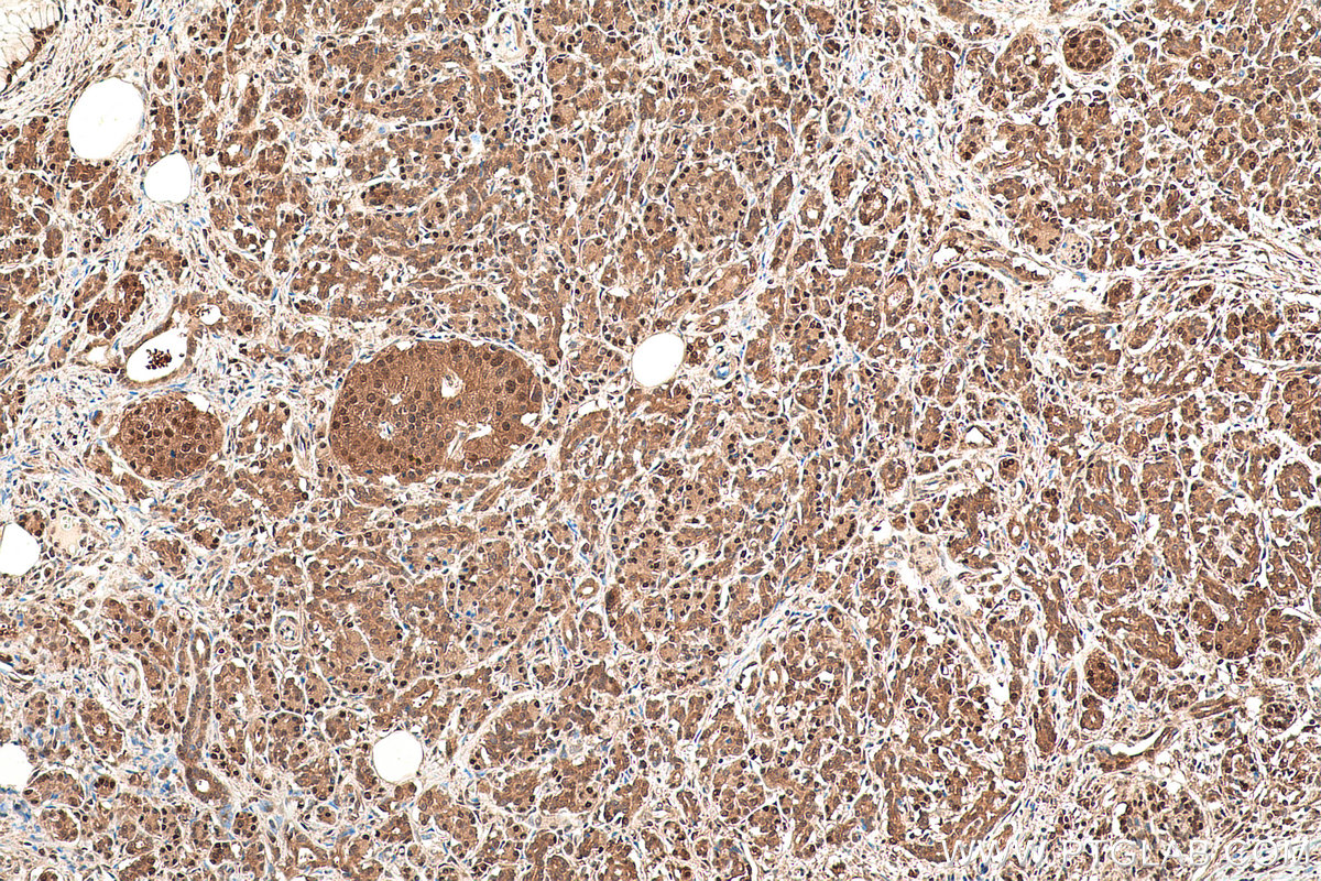 Immunohistochemical analysis of paraffin-embedded human pancreas cancer tissue slide using KHC0830 (VCP IHC Kit).