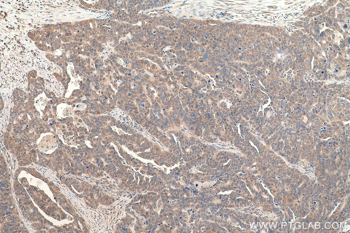 Immunohistochemical analysis of paraffin-embedded human ovary tumor tissue slide using KHC0830 (VCP IHC Kit).