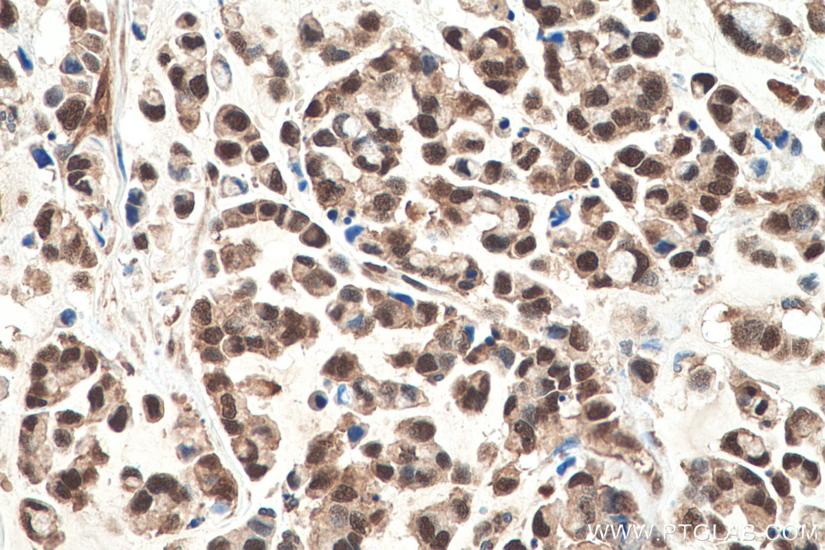 Immunohistochemical analysis of paraffin-embedded human colon cancer tissue slide using KHC0830 (VCP IHC Kit).
