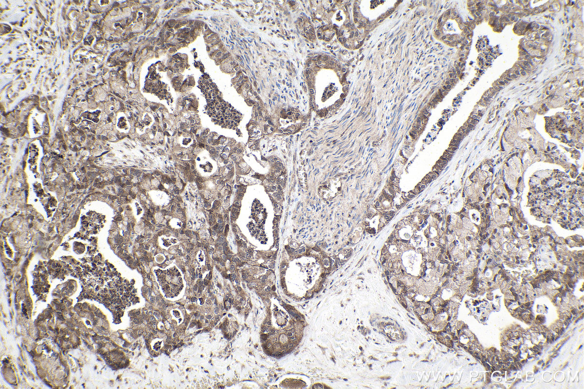 Immunohistochemical analysis of paraffin-embedded human pancreas cancer tissue slide using KHC1592 (VHL IHC Kit).