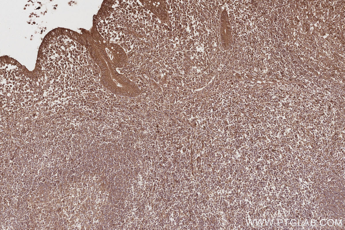 Immunohistochemical analysis of paraffin-embedded human appendicitis tissue slide using KHC2843 (VPS15 IHC Kit).