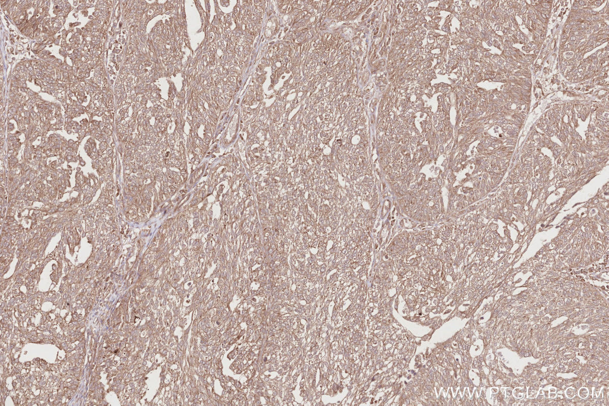 Immunohistochemical analysis of paraffin-embedded human ovary cancer tissue slide using KHC2843 (VPS15 IHC Kit).