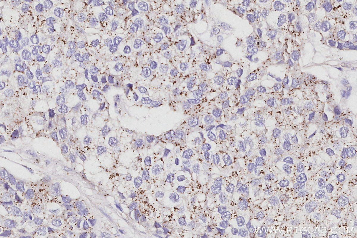 Immunohistochemical analysis of paraffin-embedded human stomach cancer tissue slide using KHC3062 (VPS24 IHC Kit). Immunohistochemical analysis of paraffin-embedded human stomach cancer tissue slide using KHC3062 (VPS24 IHC Kit).