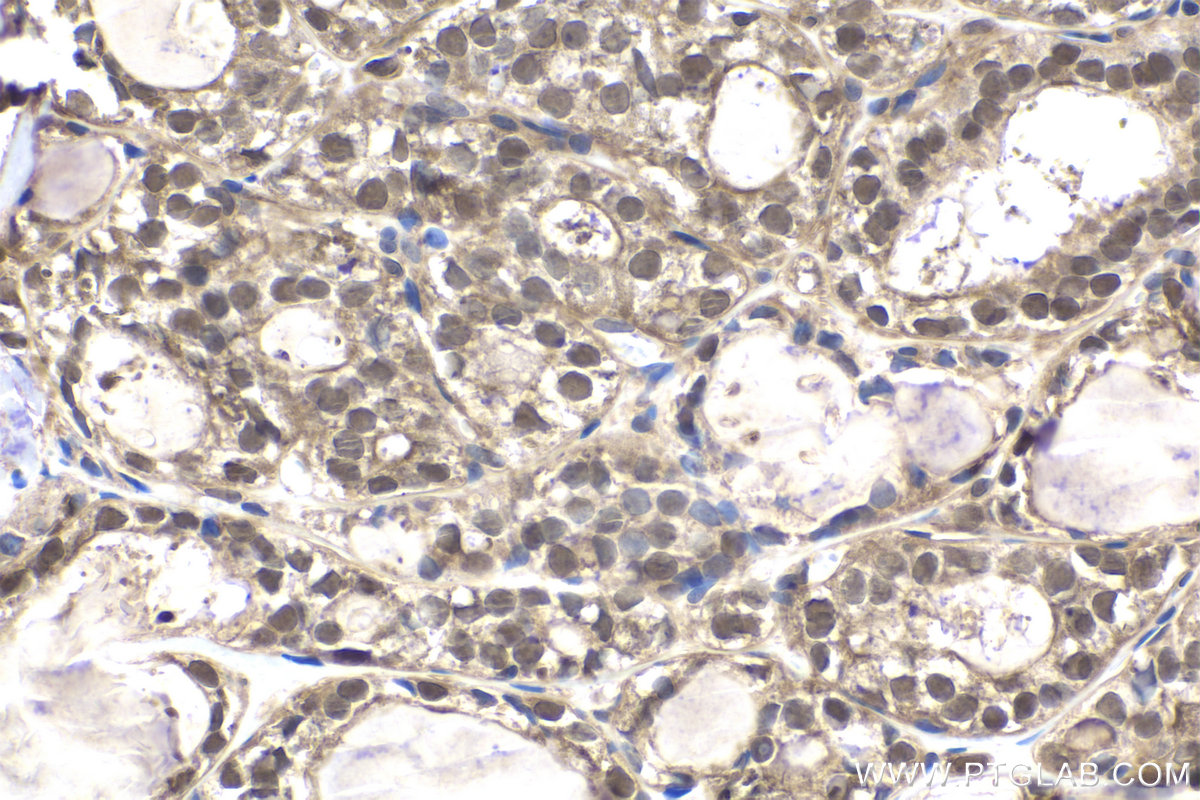 Immunohistochemical analysis of paraffin-embedded human thyroid cancer tissue slide using KHC1900 (VPS25 IHC Kit).