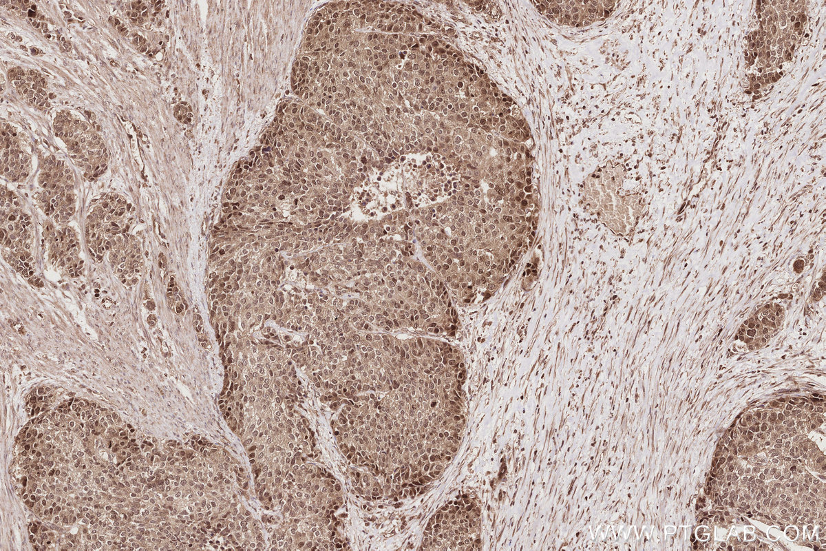 Immunohistochemical analysis of paraffin-embedded human stomach cancer tissue slide using KHC2852 (VRK1 IHC Kit).