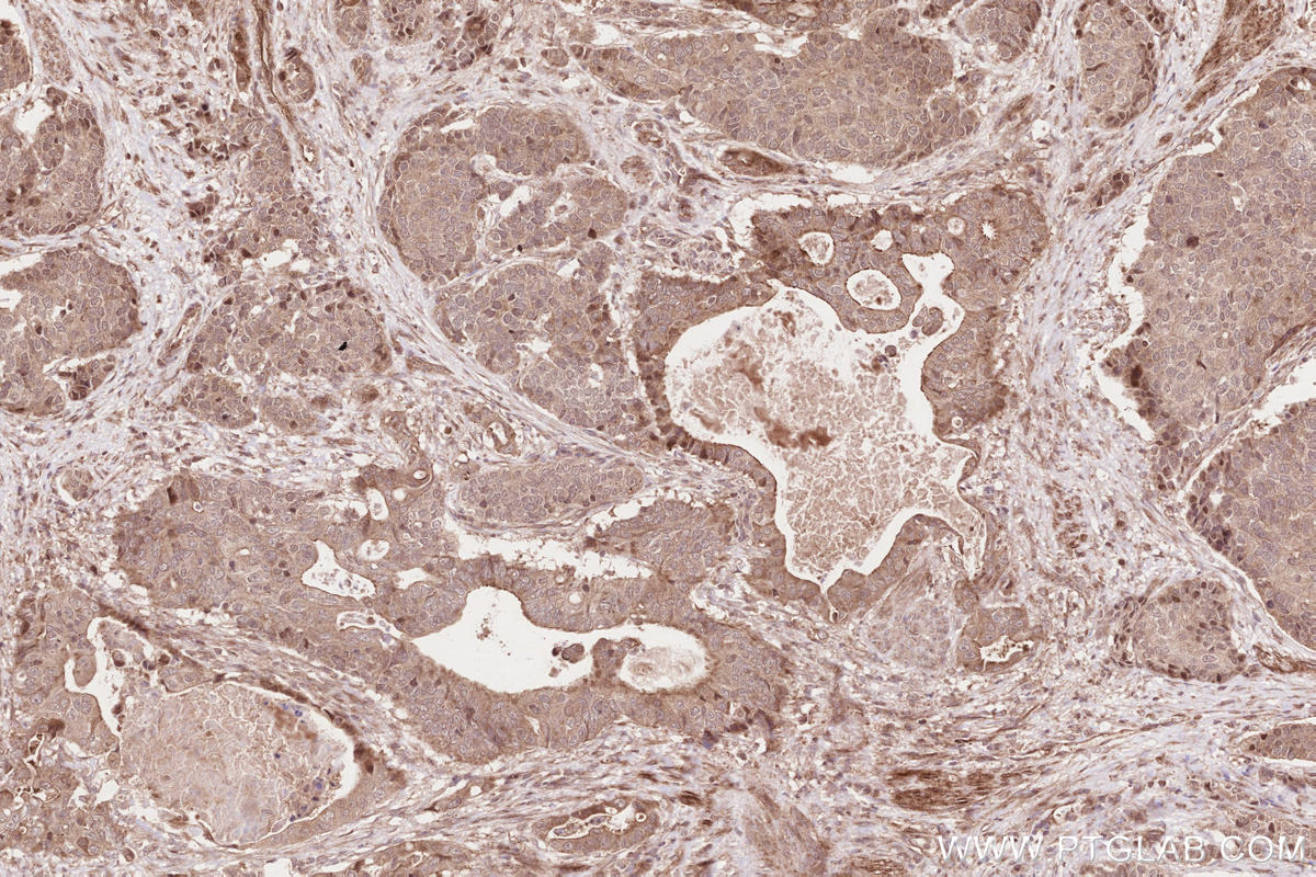 Immunohistochemical analysis of paraffin-embedded human stomach cancer tissue slide using KHC2638 (VRK2 IHC Kit).