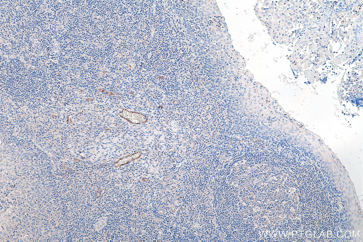 Immunohistochemical analysis of paraffin-embedded human tonsillitis tissue slide using KHC0209 (VWF IHC Kit).