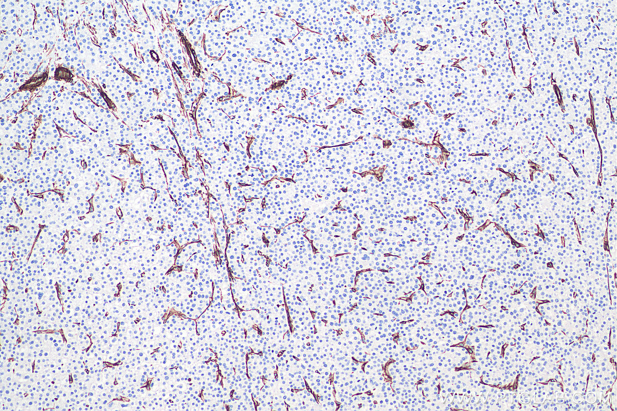 Immunohistochemical analysis of paraffin-embedded human liver cancer tissue slide using KHC0039 (Vimentin IHC Kit).