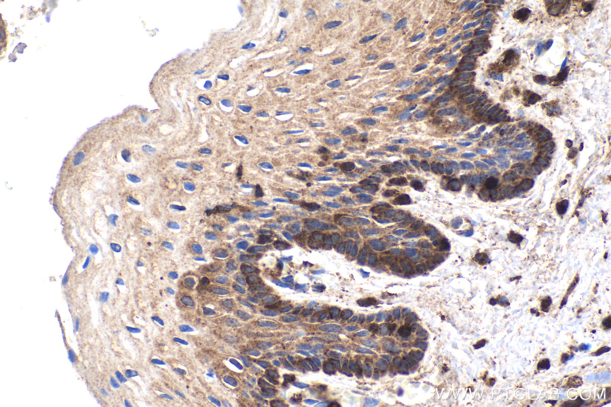 Immunohistochemical analysis of paraffin-embedded human cervical cancer tissue slide using KHC1596 (WAS IHC Kit).