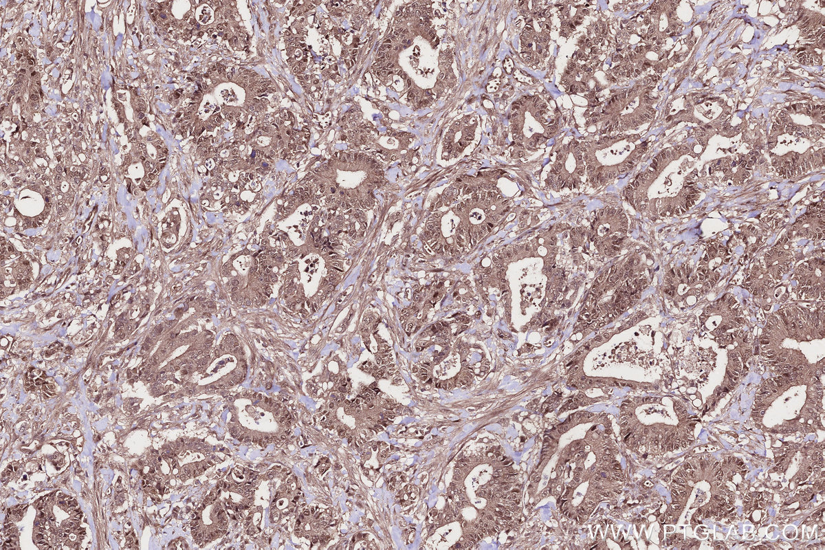Immunohistochemical analysis of paraffin-embedded human rectal cancer tissue slide using KHC2705 (WDR48 IHC Kit).
