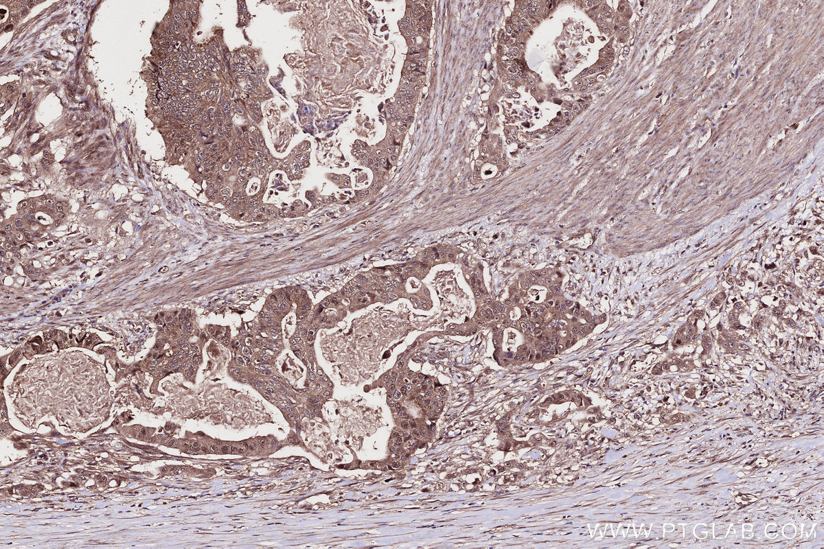 Immunohistochemical analysis of paraffin-embedded human stomach cancer tissue slide using KHC2705 (WDR48 IHC Kit).
