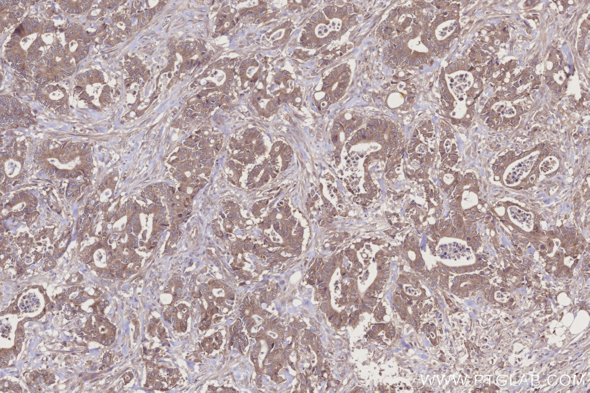 Immunohistochemical analysis of paraffin-embedded human rectal cancer tissue slide using KHC2728 (WIPF2 IHC Kit).