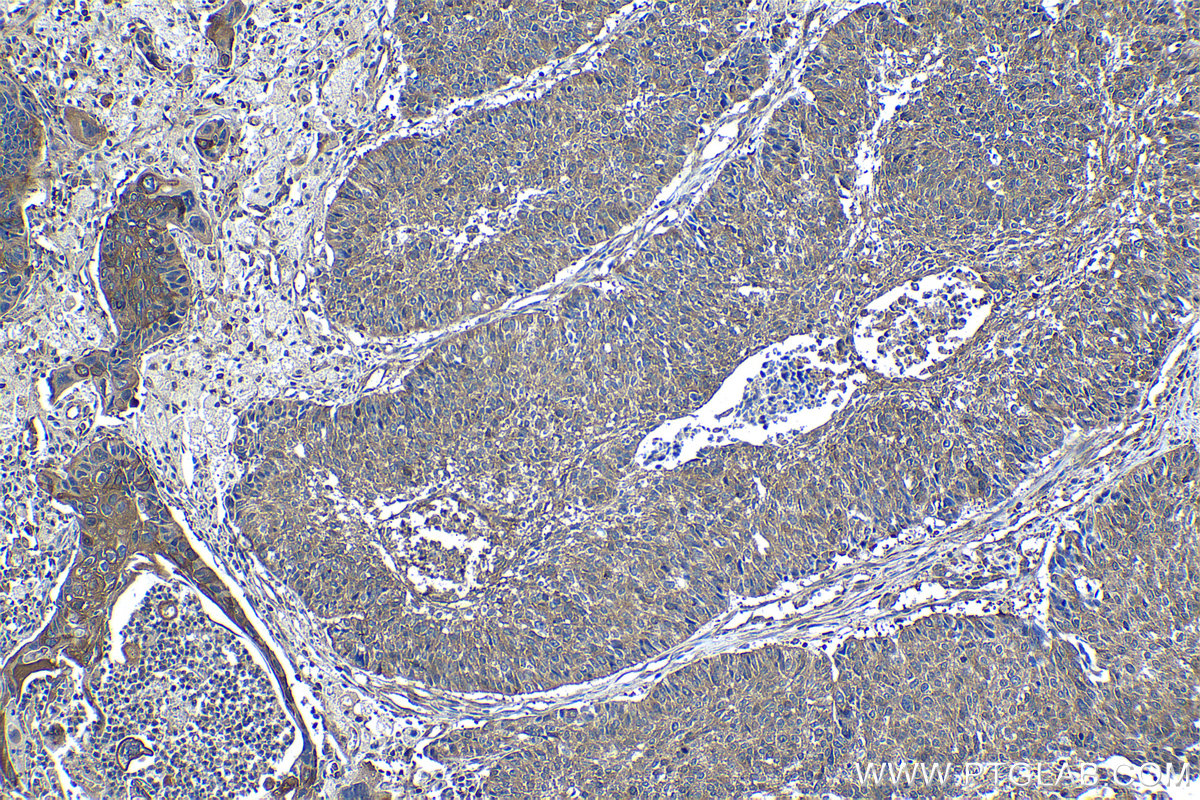 Immunohistochemical analysis of paraffin-embedded human lung cancer tissue slide using KHC1294 (WNK1 IHC Kit).