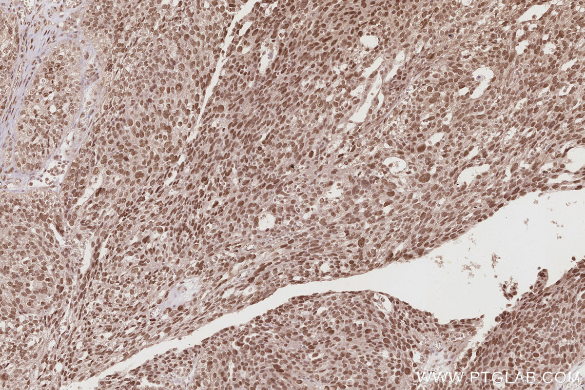 Immunohistochemical analysis of paraffin-embedded human ovary cancer tissue slide using KHC2870 (WRAP53 IHC Kit).