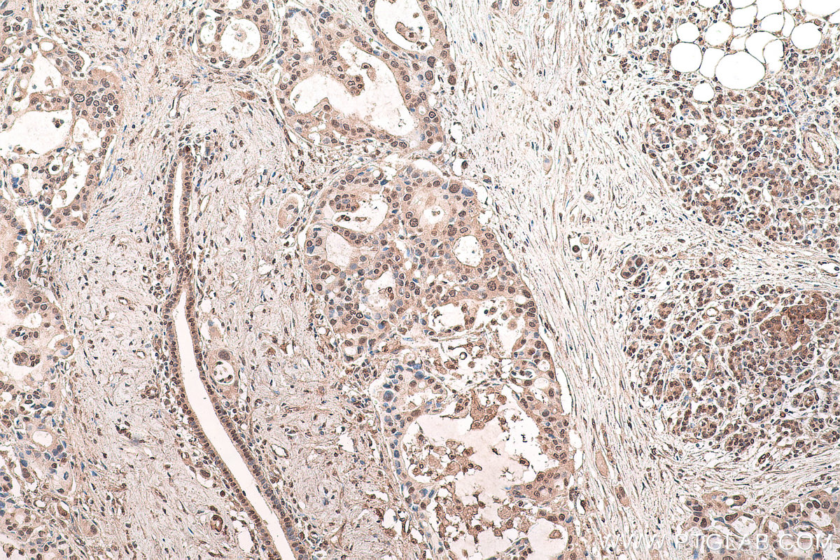 Immunohistochemical analysis of paraffin-embedded human pancreas cancer tissue slide using KHC0651 (WWOX IHC Kit).