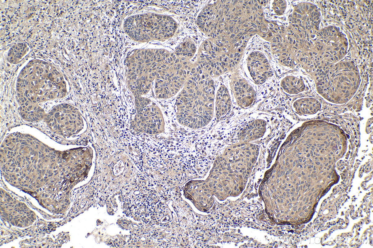 Immunohistochemical analysis of paraffin-embedded human lung cancer tissue slide using KHC1920 (WWP1 IHC Kit).